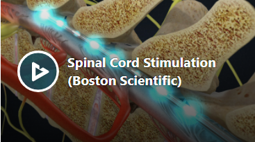 Spinal Chord Stimulation